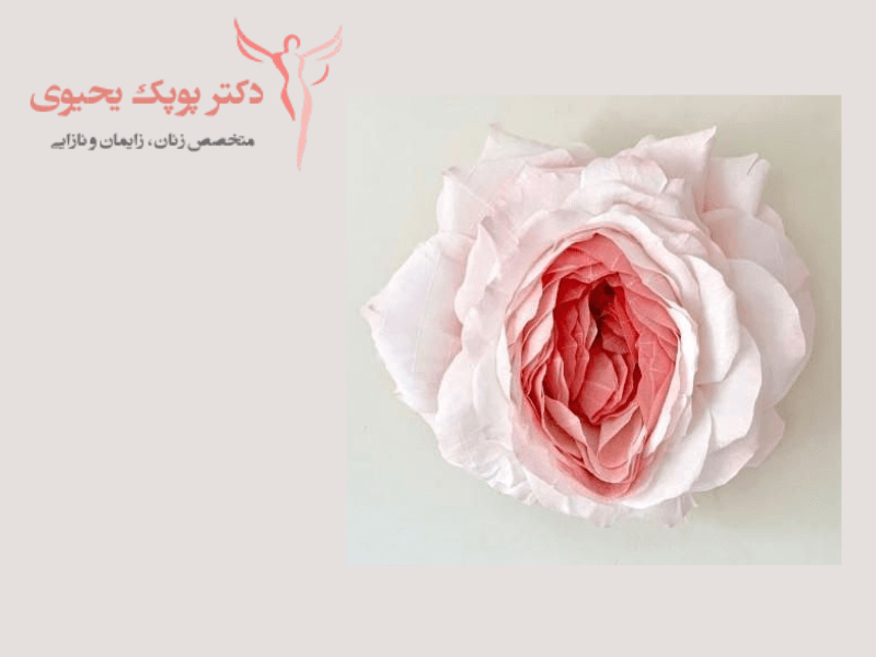 ماندکاری-لابیاپلاستی