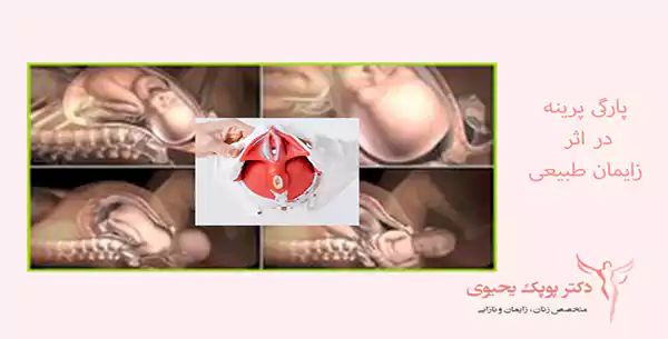 پارگی-پرینه-بعد-زایمان-طبیعی