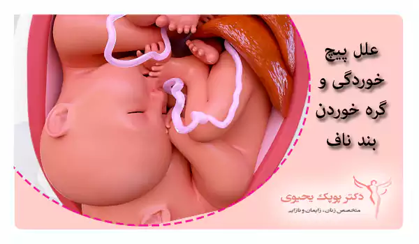 علل پیچ خوردگی و گره خوردن بند ناف