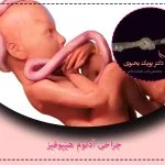 گره خوردن بند ناف جنین