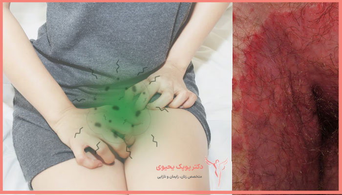 تشخیص علت خارش ناحیه تناسلی