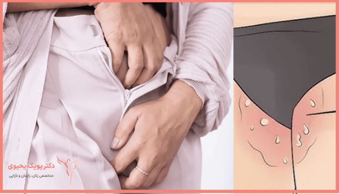 سوزش و خارش ناحیه تناسلی نشانه چیست؟